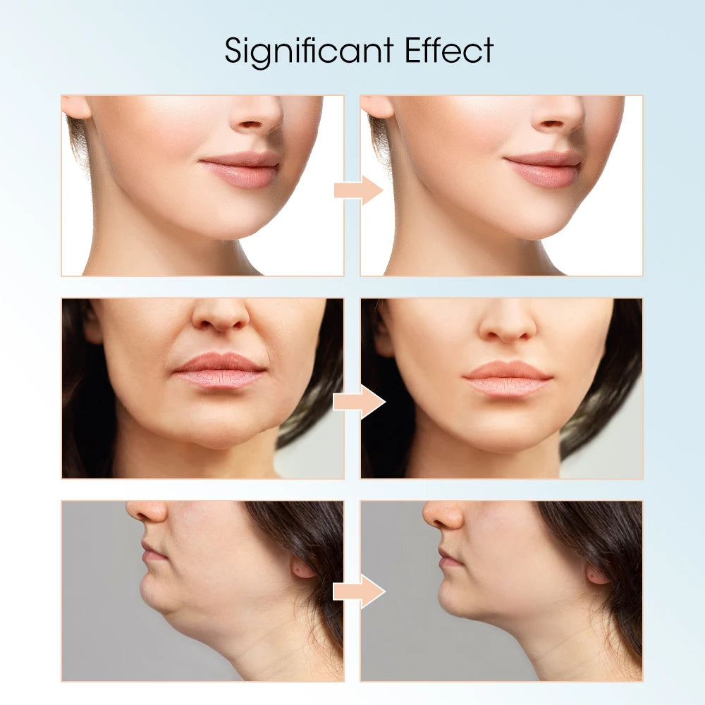 V-Line Face Slimming and Lifting Device
